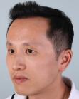 After Hair Transplant&nbsp;Front